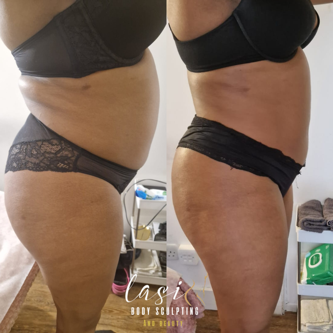 before and after mummy makeover bundle